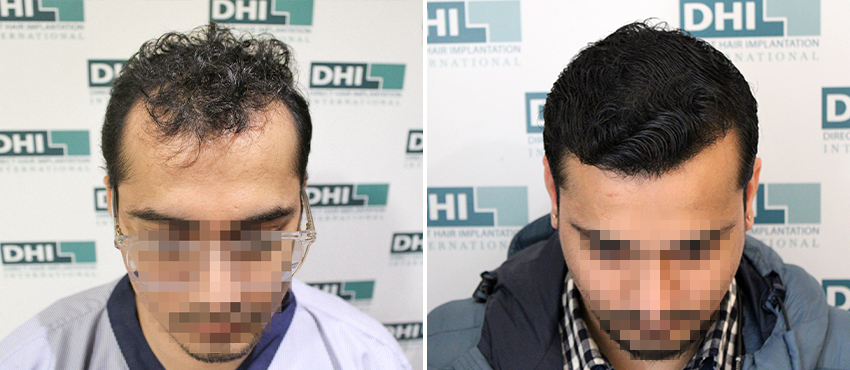 DHI before & after hair transplant results